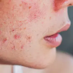 Jakie kosmetyki wybrać na kaszkę na twarzy? Skuteczne sposoby i porady dermatologiczne