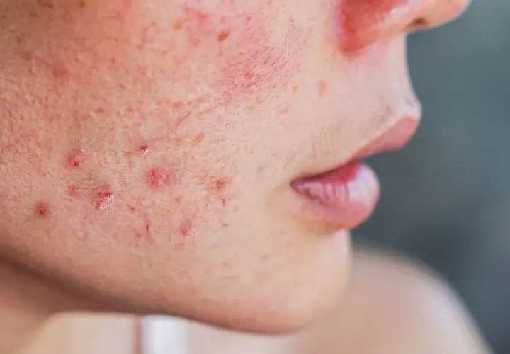 Jakie kosmetyki wybrać na kaszkę na twarzy? Skuteczne sposoby i porady dermatologiczne