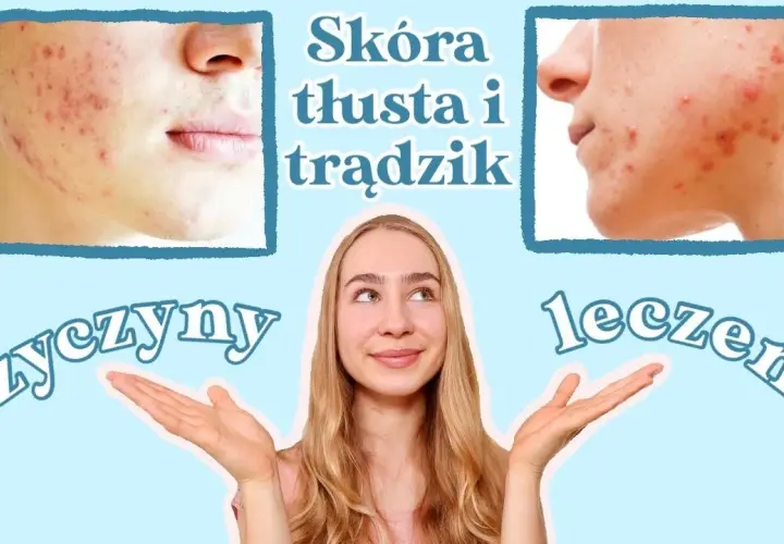 Jak skutecznie pozbyć się tłustej cery – sprawdzone metody i porady