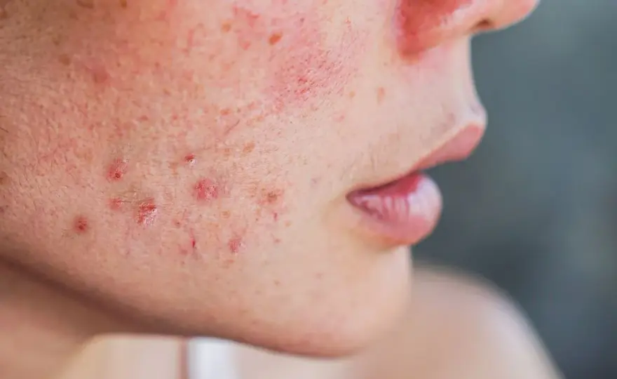 Jakie kosmetyki wybrać na kaszkę na twarzy? Skuteczne sposoby i porady dermatologiczne